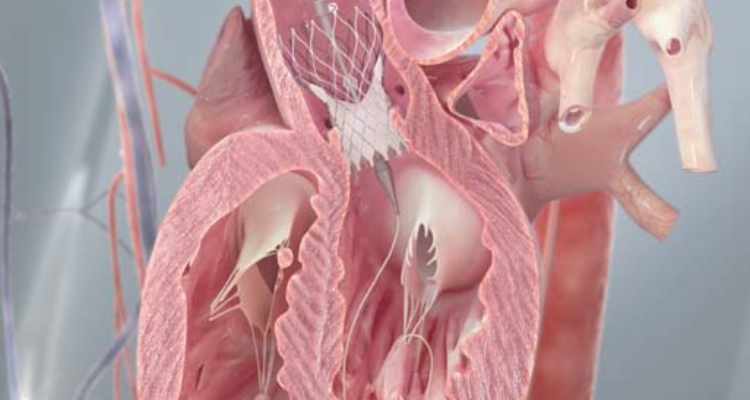 TAVR Procedure