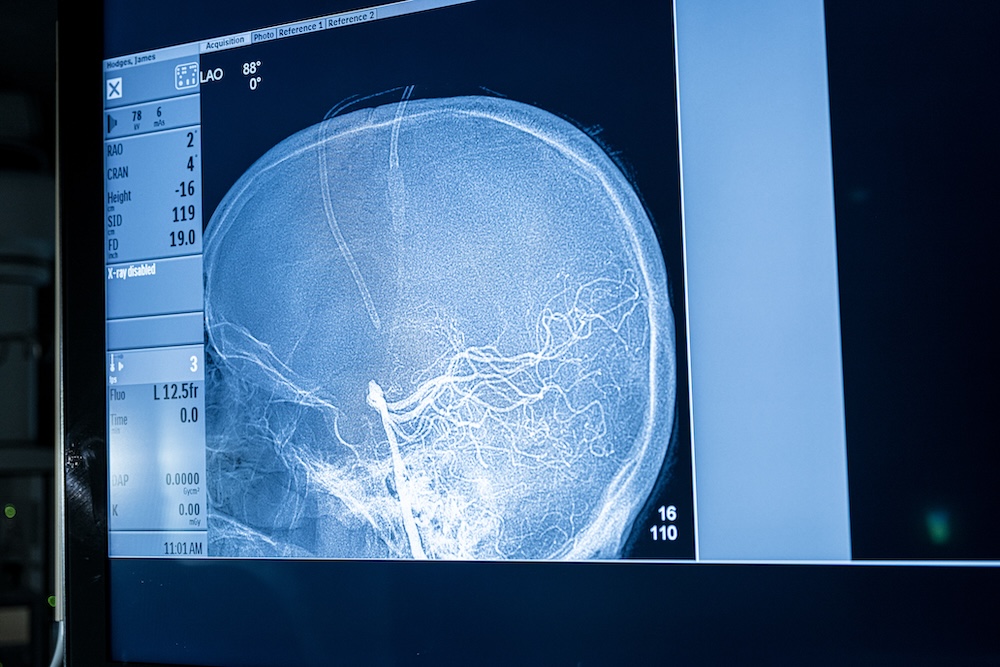Brain X-Ray
