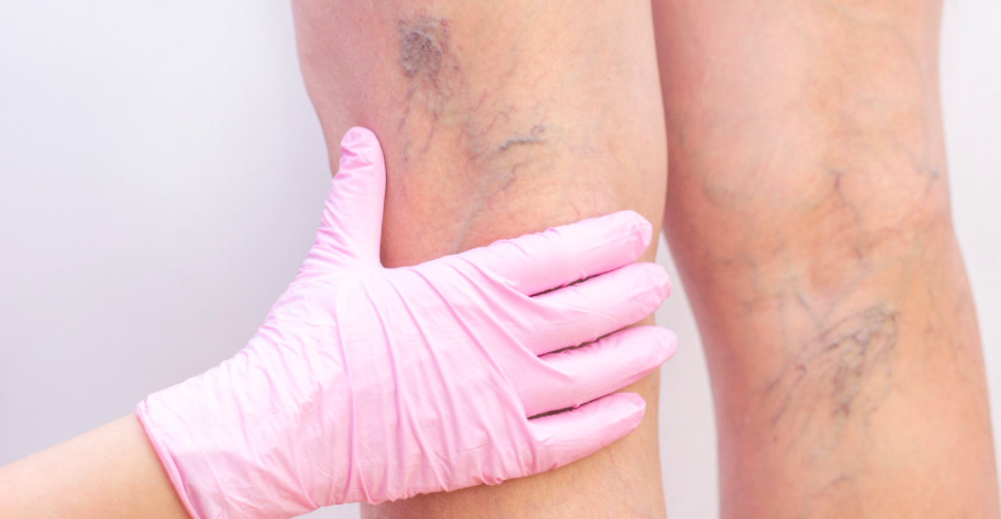 Photo of person with Varicose Veins