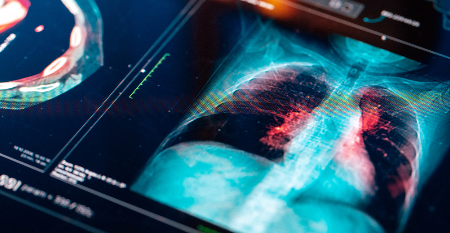 Lung Cancer on X-Ray