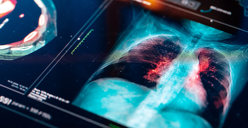 Lung Cancer on X-Ray