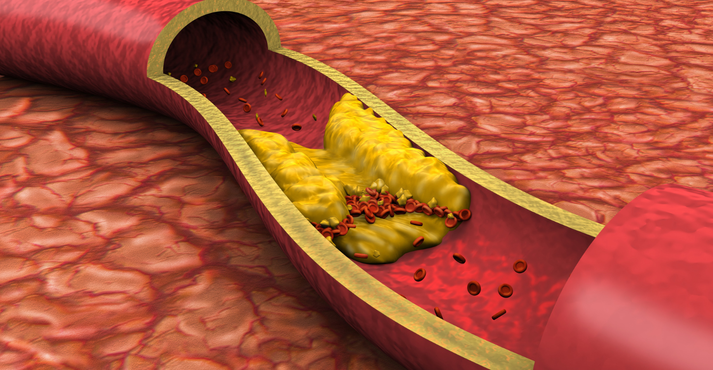 Graphic of a blocked artery