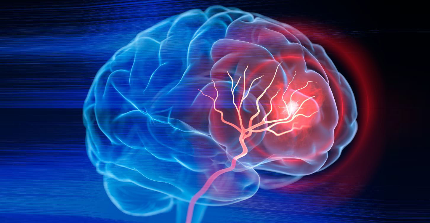 where a stroke can occur in the brain