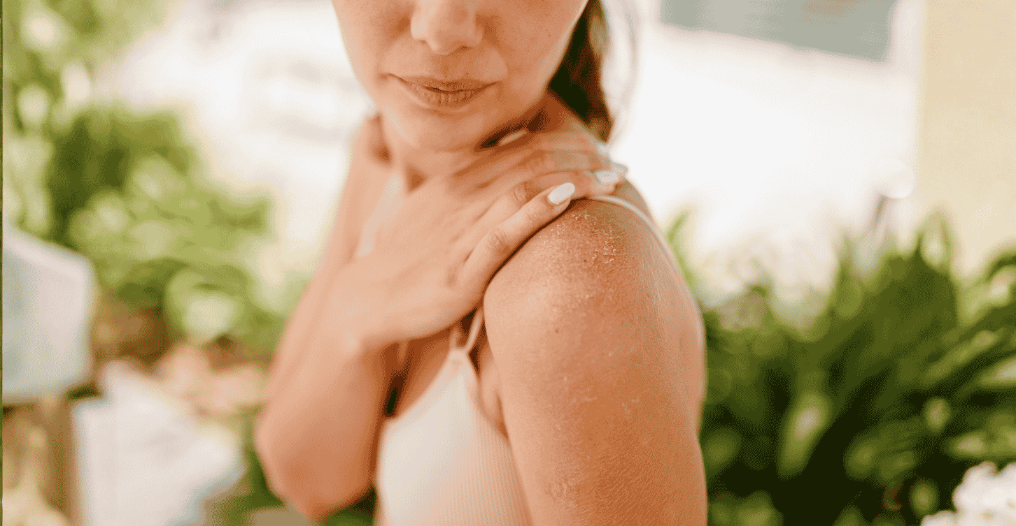 Woman's Sunburned Back