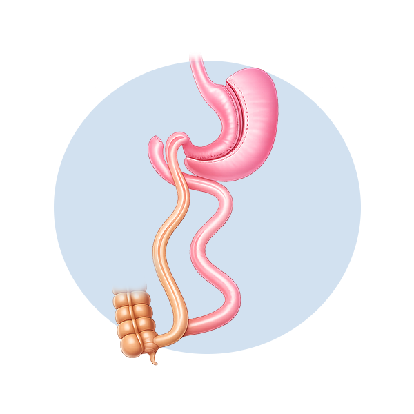 Illustration of duodenal switch surgery