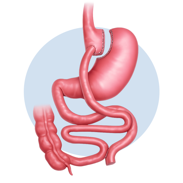 Illustration of a gastric bypass procedure