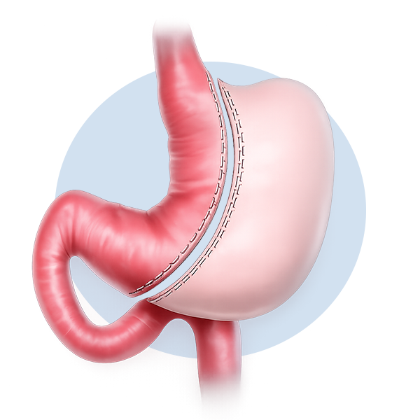Illustration of a gastric sleeve procedure