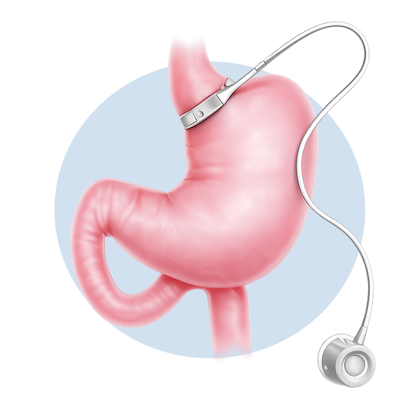 Illustration of bariatric revision surgery