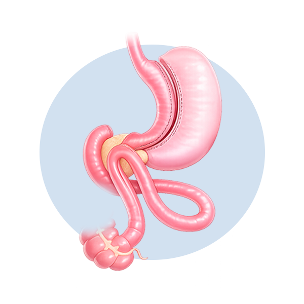 Illustration of Single Anastomosis Duodeno-Ileal Bypass with Sleeve surgery