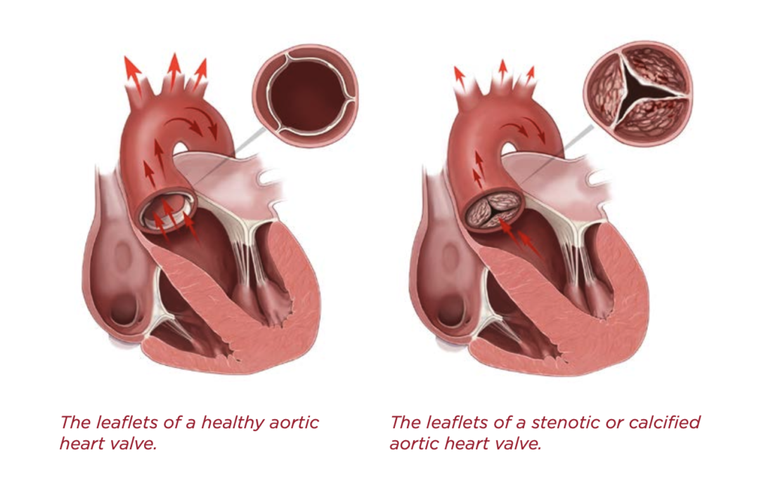 Aortic stenosis illustration