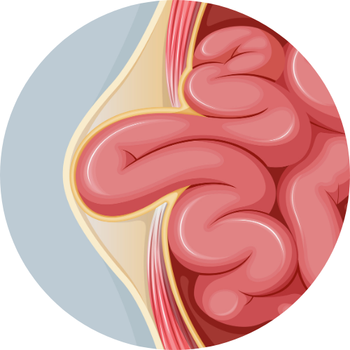 Hernia graphic
