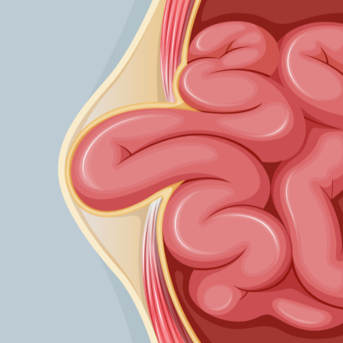 Hernia graphic